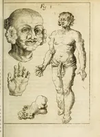 An illustration from Miscellanea Curiosa, sive Ephemiridum Medico-Physicarum Germanicarum Academiae Naturae Curiosorum (1684)