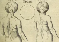 An illustration from Miscellanea Curiosa Medico-Physica Academiae Naturae Curiosorum (1672)