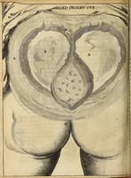 An illustration from Miscellanea Curiosa Medico-Physica Academiae Naturae Curiosorum (1672)