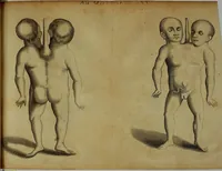 An illustration from Miscellanea Curiosa Medico-Physica Academiae Naturae Curiosorum (1672)