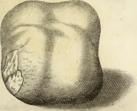 An illustration from Miscellanea Curiosa Medico-Physica Academiae Naturae Curiosorum (1672)