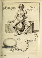 An illustration from Miscellanea Curiosa, sive Ephemiridum Medico-Physicarum Germanicarum Academiae Naturae Curiosorum (1689)