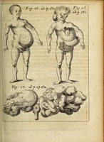 An illustration from Miscellanea Curiosa, sive Ephemiridum Medico-Physicarum Germanicarum Academiae Naturae Curiosorum (1691)