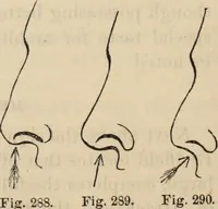 Picture 181 of 697 from New Physiognomy : or signs of character, as manifested through temperament and external forms, and especially in the "the human face divine." (1889), leaf 215
