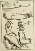 An illustration from Observations chirvrgiqves (1669)