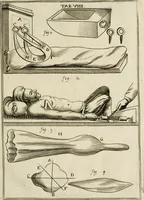 An illustration from Observations chirvrgiqves (1669)
