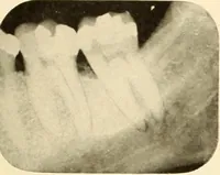 Picture 66 of 158 from Oral Roentgenology : a Roentgen study of the anatomy and pathology of the oral cavity (1917), leaf 100
