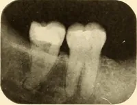 An illustration from Oral Roentgenology : a Roentgen study of the anatomy and pathology of the oral cavity (1917)