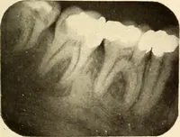 Picture 68 of 158 from Oral Roentgenology : a Roentgen study of the anatomy and pathology of the oral cavity (1917), leaf 100