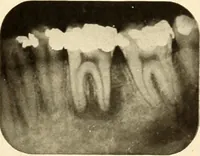 Picture 69 of 158 from Oral Roentgenology : a Roentgen study of the anatomy and pathology of the oral cavity (1917), leaf 100