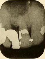 Picture 70 of 158 from Oral Roentgenology : a Roentgen study of the anatomy and pathology of the oral cavity (1917), leaf 102