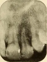 An illustration from Oral Roentgenology : a Roentgen study of the anatomy and pathology of the oral cavity (1917)
