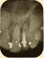 Picture 72 of 158 from Oral Roentgenology : a Roentgen study of the anatomy and pathology of the oral cavity (1917), leaf 104