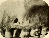 Picture 74 of 158 from Oral Roentgenology : a Roentgen study of the anatomy and pathology of the oral cavity (1917), leaf 106