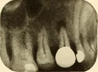 Picture 75 of 158 from Oral Roentgenology : a Roentgen study of the anatomy and pathology of the oral cavity (1917), leaf 106