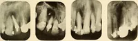 An illustration from Oral Roentgenology : a Roentgen study of the anatomy and pathology of the oral cavity (1917)