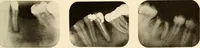 Picture 77 of 158 from Oral Roentgenology : a Roentgen study of the anatomy and pathology of the oral cavity (1917), leaf 106