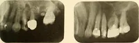 An illustration from Oral Roentgenology : a Roentgen study of the anatomy and pathology of the oral cavity (1917)