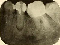 Picture 79 of 158 from Oral Roentgenology : a Roentgen study of the anatomy and pathology of the oral cavity (1917), leaf 108