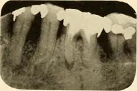 Picture 80 of 158 from Oral Roentgenology : a Roentgen study of the anatomy and pathology of the oral cavity (1917), leaf 108