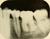 Picture 82 of 158 from Oral Roentgenology : a Roentgen study of the anatomy and pathology of the oral cavity (1917), leaf 110