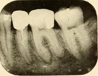 An illustration from Oral Roentgenology : a Roentgen study of the anatomy and pathology of the oral cavity (1917)