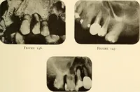 An illustration from Oral Roentgenology : a Roentgen study of the anatomy and pathology of the oral cavity (1917)