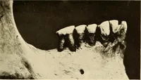 An illustration from Oral Roentgenology : a Roentgen study of the anatomy and pathology of the oral cavity (1917)
