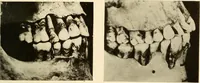 An illustration from Oral Roentgenology : a Roentgen study of the anatomy and pathology of the oral cavity (1917)