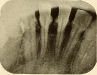 Picture 88 of 158 from Oral Roentgenology : a Roentgen study of the anatomy and pathology of the oral cavity (1917), leaf 116