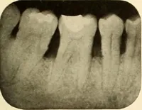 Picture 89 of 158 from Oral Roentgenology : a Roentgen study of the anatomy and pathology of the oral cavity (1917), leaf 118