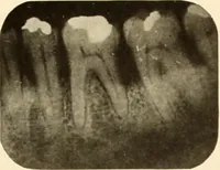 Picture 90 of 158 from Oral Roentgenology : a Roentgen study of the anatomy and pathology of the oral cavity (1917), leaf 118