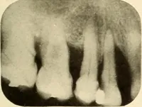 Picture 91 of 158 from Oral Roentgenology : a Roentgen study of the anatomy and pathology of the oral cavity (1917), leaf 118