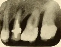 Picture 92 of 158 from Oral Roentgenology : a Roentgen study of the anatomy and pathology of the oral cavity (1917), leaf 118
