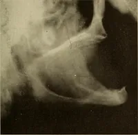 An illustration from Oral Roentgenology : a Roentgen study of the anatomy and pathology of the oral cavity (1917)