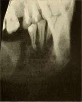 An illustration from Oral Roentgenology : a Roentgen study of the anatomy and pathology of the oral cavity (1917)