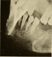 An illustration from Oral Roentgenology : a Roentgen study of the anatomy and pathology of the oral cavity (1917)