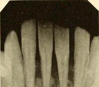 An illustration from Oral Roentgenology : a Roentgen study of the anatomy and pathology of the oral cavity (1917)