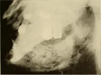 An illustration from Oral Roentgenology : a Roentgen study of the anatomy and pathology of the oral cavity (1917)