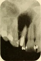 Picture 101 of 158 from Oral Roentgenology : a Roentgen study of the anatomy and pathology of the oral cavity (1917), leaf 136