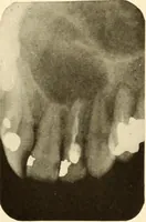 Picture 102 of 158 from Oral Roentgenology : a Roentgen study of the anatomy and pathology of the oral cavity (1917), leaf 136