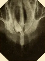 An illustration from Oral Roentgenology : a Roentgen study of the anatomy and pathology of the oral cavity (1917)