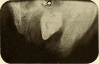 Picture 106 of 158 from Oral Roentgenology : a Roentgen study of the anatomy and pathology of the oral cavity (1917), leaf 138