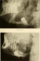 An illustration from Oral Roentgenology : a Roentgen study of the anatomy and pathology of the oral cavity (1917)