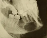 Picture 108 of 158 from Oral Roentgenology : a Roentgen study of the anatomy and pathology of the oral cavity (1917), leaf 144