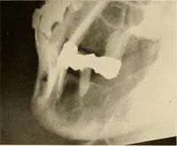 An illustration from Oral Roentgenology : a Roentgen study of the anatomy and pathology of the oral cavity (1917)
