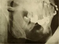 An illustration from Oral Roentgenology : a Roentgen study of the anatomy and pathology of the oral cavity (1917)