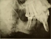 Picture 111 of 158 from Oral Roentgenology : a Roentgen study of the anatomy and pathology of the oral cavity (1917), leaf 146