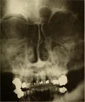 Picture 112 of 158 from Oral Roentgenology : a Roentgen study of the anatomy and pathology of the oral cavity (1917), leaf 148
