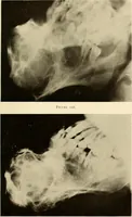 An illustration from Oral Roentgenology : a Roentgen study of the anatomy and pathology of the oral cavity (1917)
